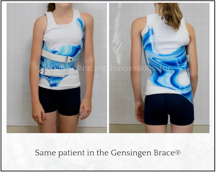 Comparing Scoliosis Braces - Scoliosis Bracing Innovations